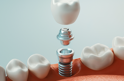 Dental Implants in Rolling Meadows, IL