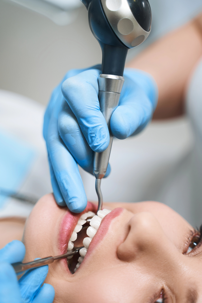 composite fillings