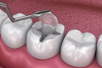 Tooth Filling in Rolling Meadows, IL