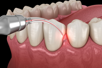 Laser for Gum Disease in Rolling Meadows, IL
