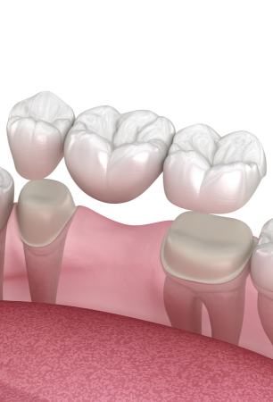 Dental Crowns & Bridges