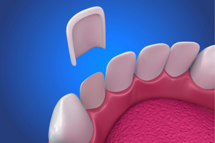 Veneers in Rolling Meadows, IL