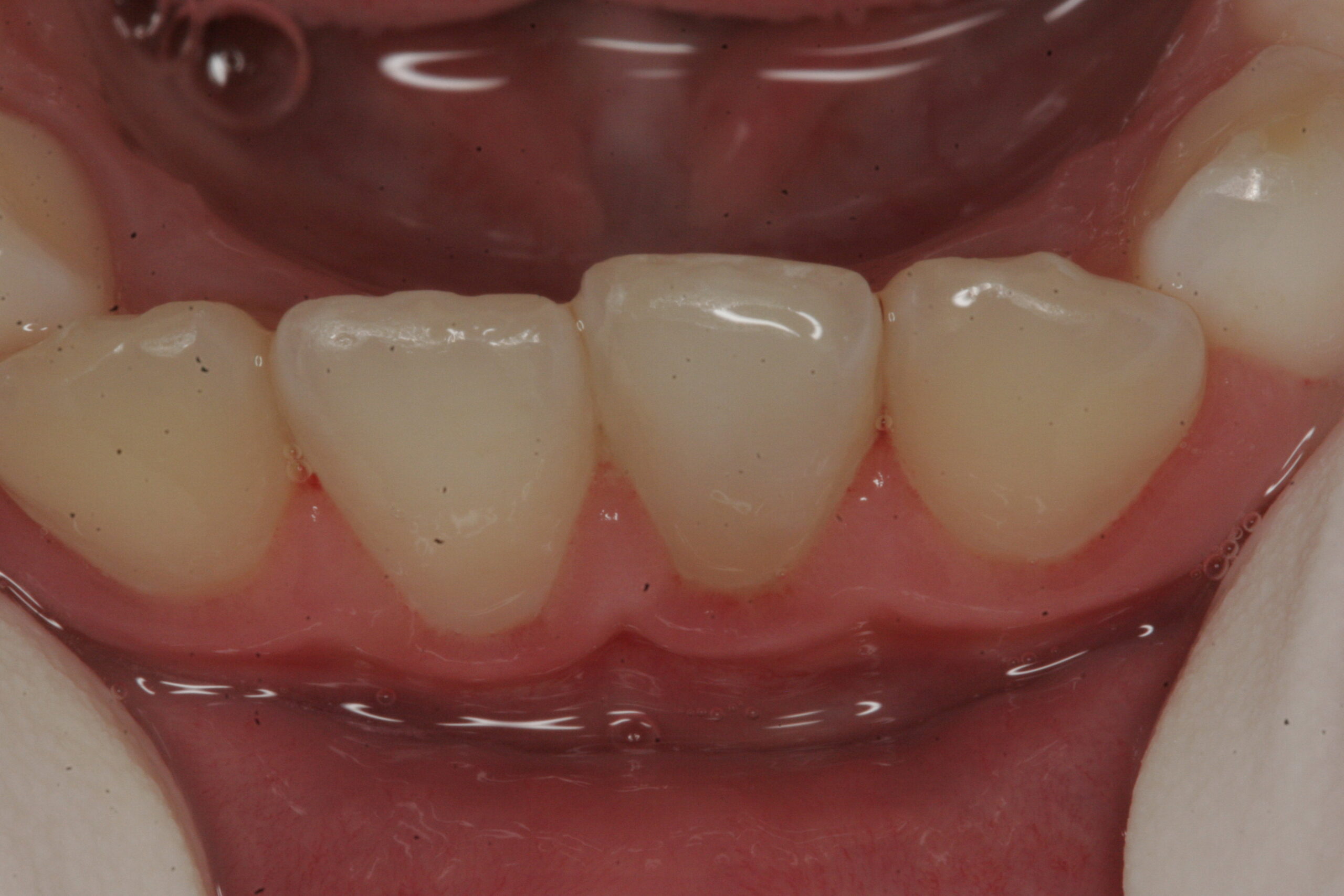 Innovative Dental - Broken Tooth - Case 1 - After