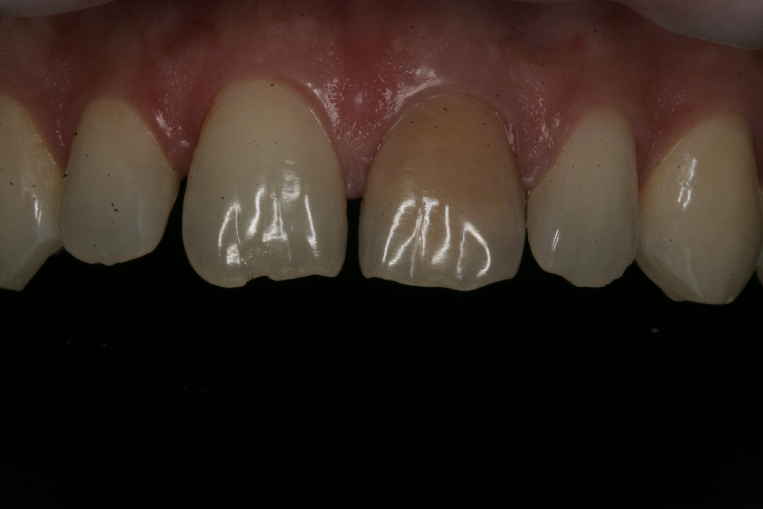 Innovative Dental - Crowns - Case 1 - Before