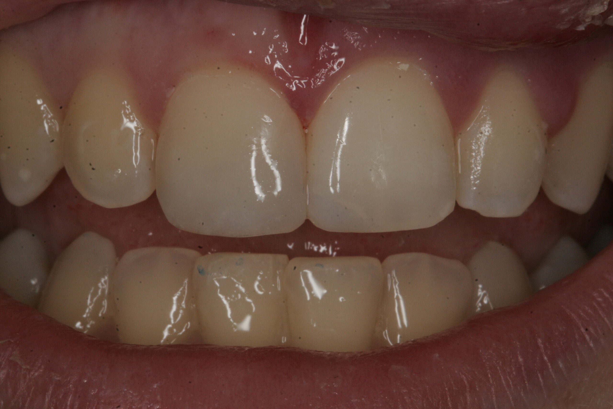 Innovative Dental - Fractured Teeth - Case 1 - After