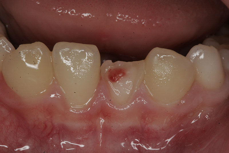 Innovative Dental - Broken Tooth - Case 1 - Before