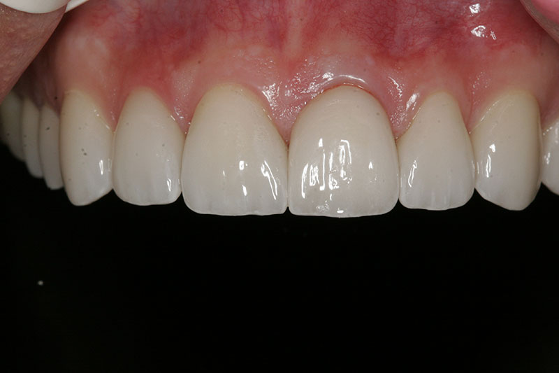 Innovative Dental - Crowns - Case 1 - After