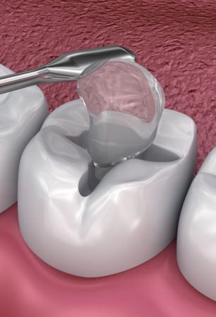 Dental Cavity Fillings