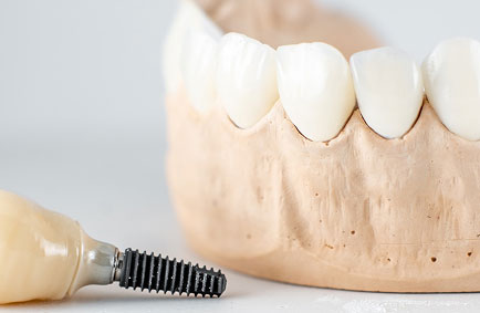 Dental Crowns & Bridges