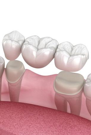 Dental Crowns and Dental Bridges