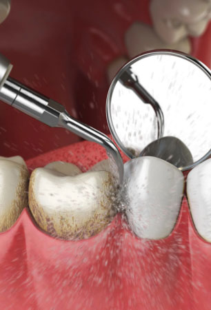 Dental Exams & Teeth Cleanings