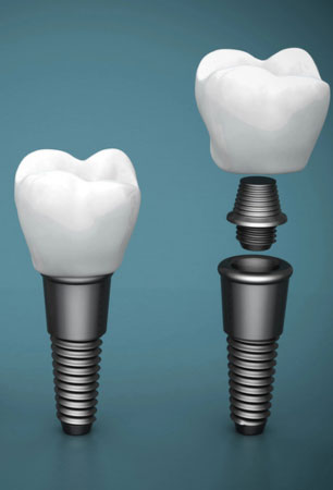 Dental Implant Dentist