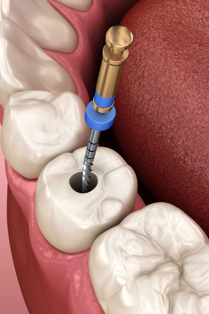Endodontic Treatment