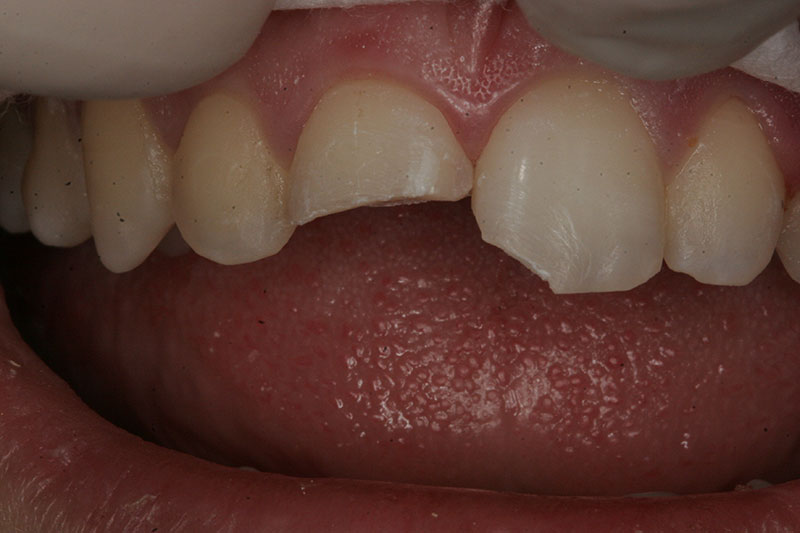 Innovative Dental - Fractured Teeth - Case 1 - Before