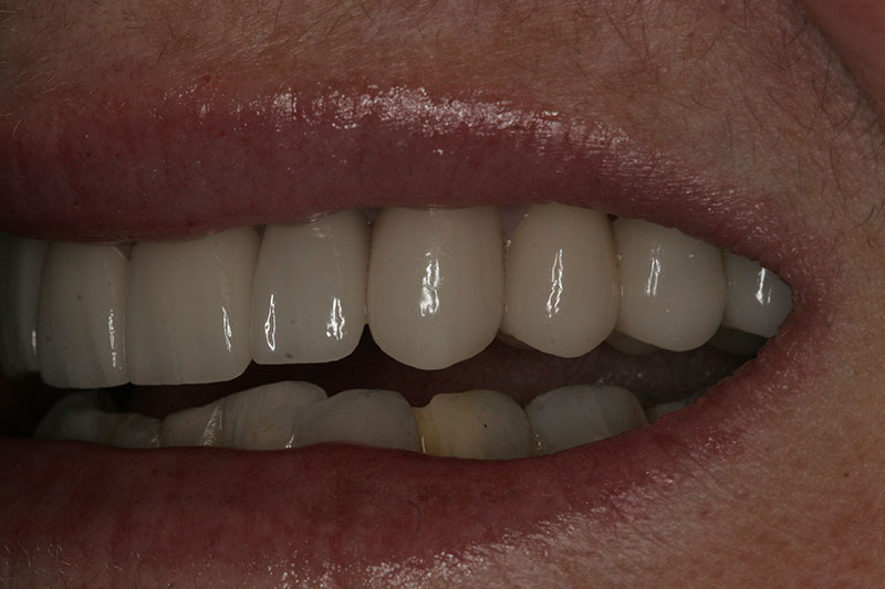 Innovative Dental - Full Maxillary Crown - Case 1 - After