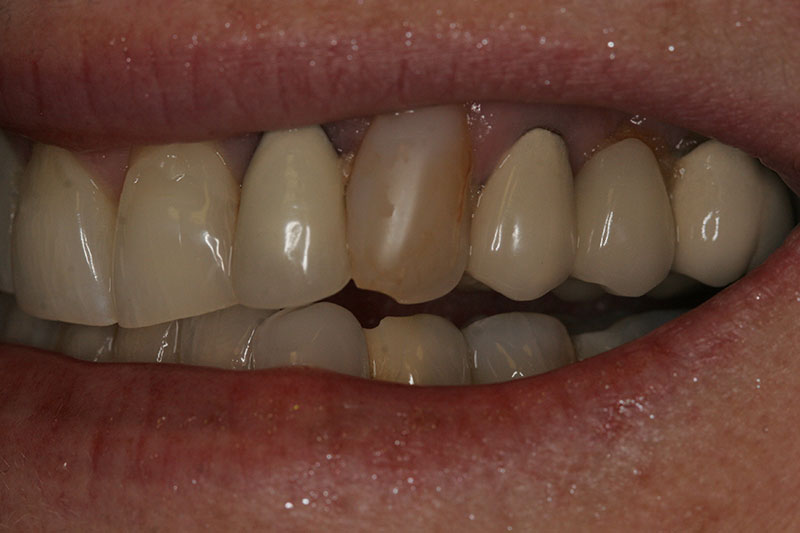 Innovative Dental - Full Maxillary Crown - Case 1 - Before