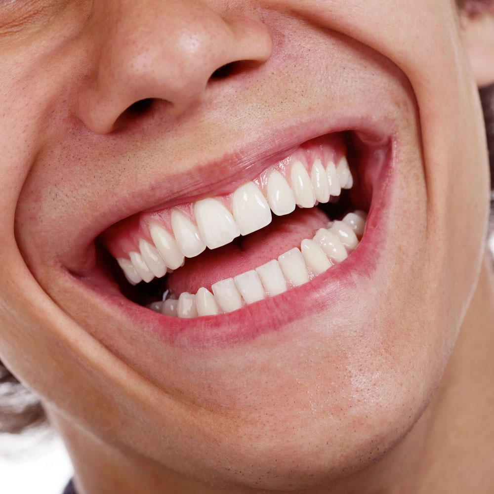 Invisalign Aligners