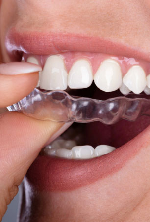 Invisalign