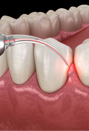 Laser Periodontal Pocket Therapy